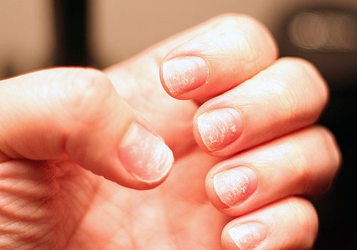 Deficienta de fier - 5 alimente care o combat si te ajuta sa slabesti