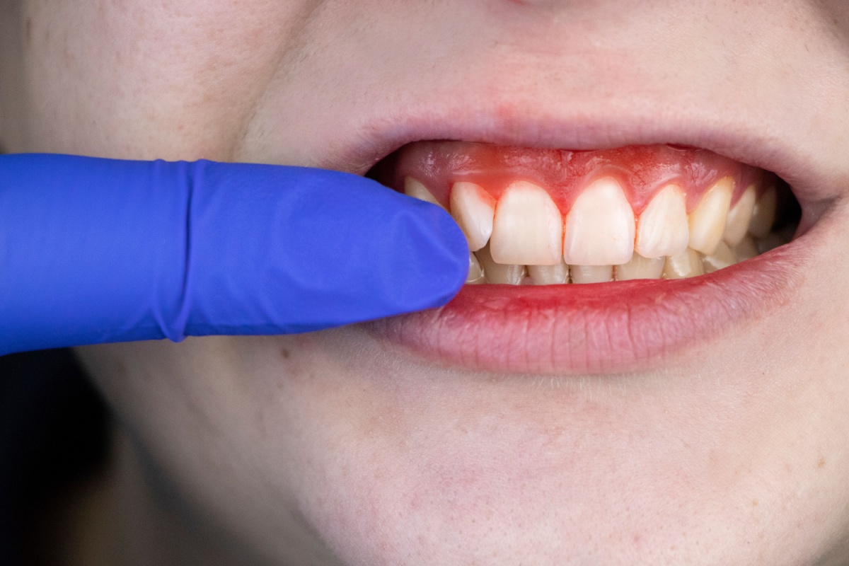 Cum sa recunosti si sa previi inflamatiile gingivale