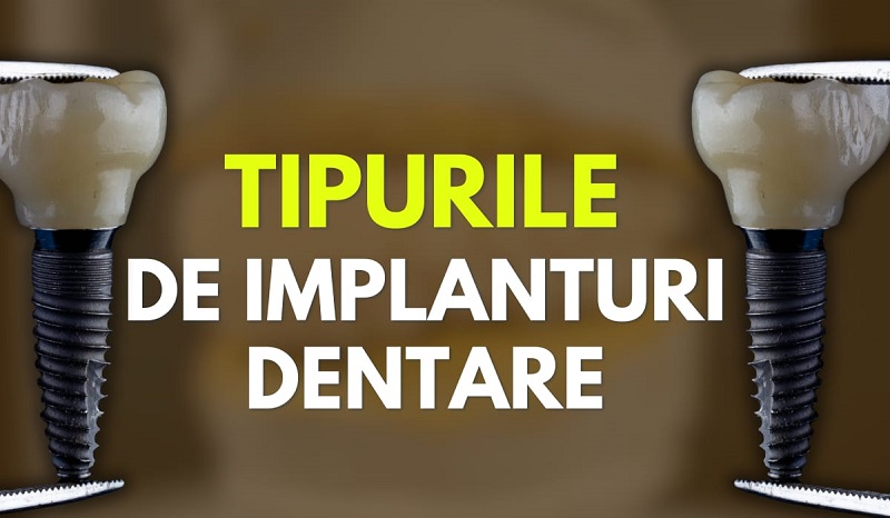 Care sunt tipurile de implanturi dentare?