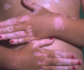 Remedii naturiste pentru vitiligo