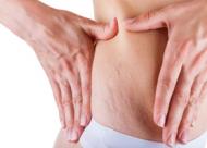 5 remedii naturale pentru a combate vergeturile