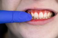 Cum sa recunosti si sa previi inflamatiile gingivale