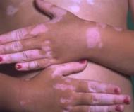 Remedii naturiste pentru vitiligo