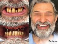 Dintii lipsa, problema tacuta care schimba forma fetei si felul in care mananci