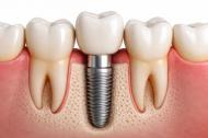 Implant dentar pret in 2026: ce trebuie sa stii inainte de tratament