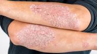 Ce este psoriazisul: Cauze, semne si simptome, forme de tratament