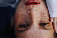 Vitiligo - Cauze si simptome